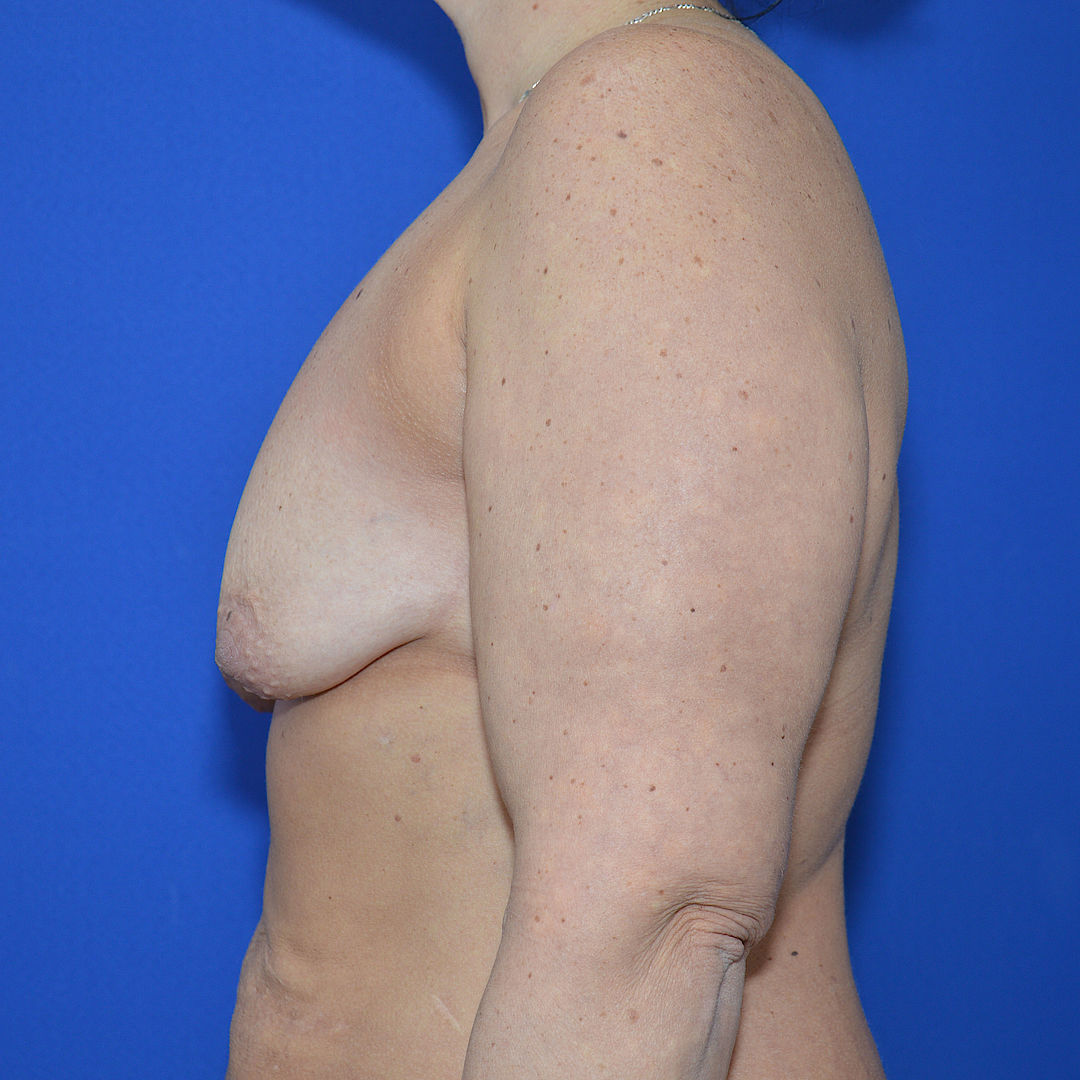 Bruststraffung mit Implantat, 45 Vorher Nachher