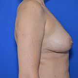 Bruststraffung mit Implantat, 49