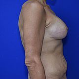 Bruststraffung mit Implantat, 33