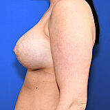 Bruststraffung mit Implantat, 34
