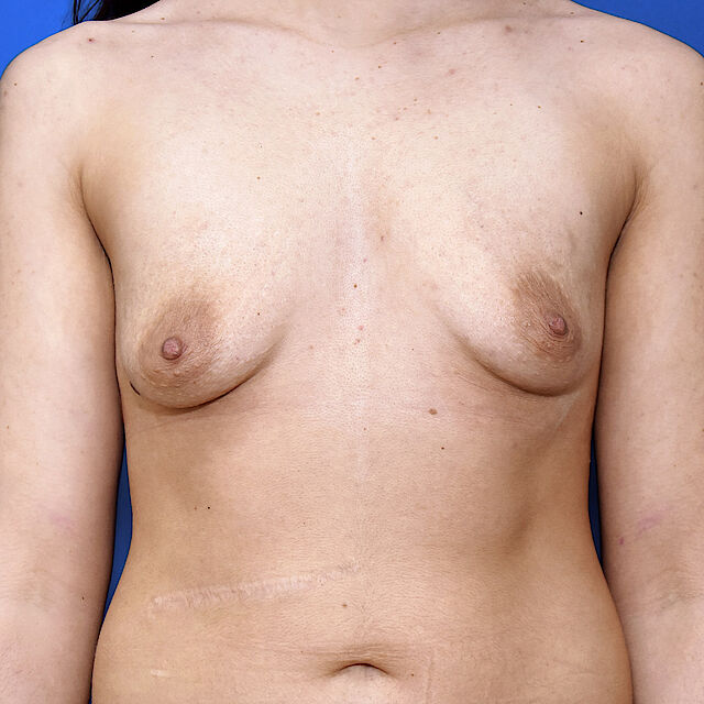 Bruststraffung mit Implantat, 26