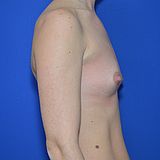 Brustvergrößerung, 36