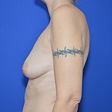 Bruststraffung mit Implantat, 48