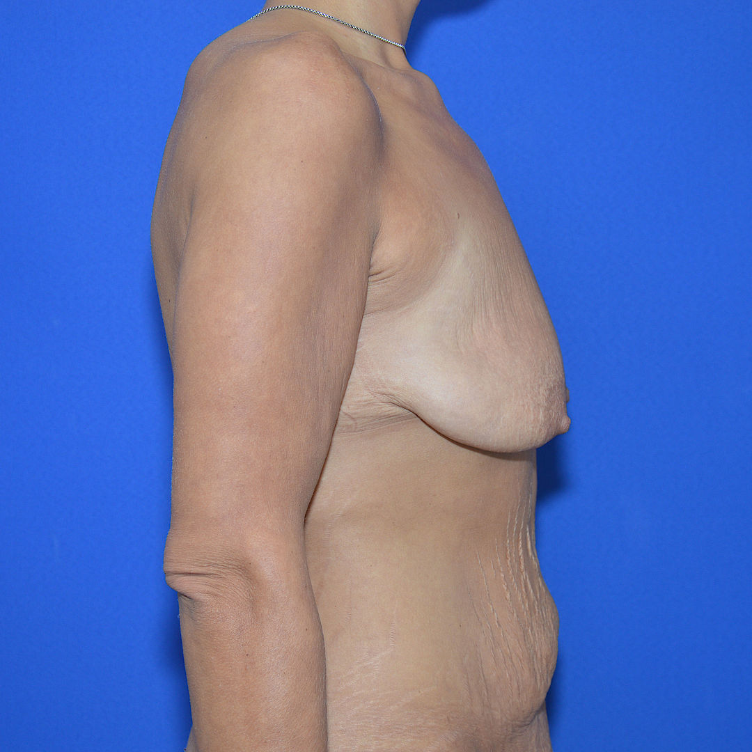 Bruststraffung mit Implantat, 33 Vorher Nachher