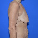 Bruststraffung mit Implantat, 33