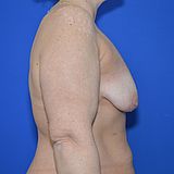 Bruststraffung mit Implantat, 45